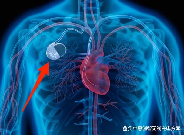 体内植入医疗电子产品的无线充电方案 应用现状与未来展望